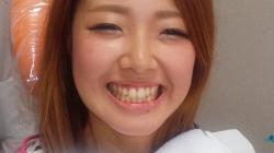初めてのホワイトニングでこんなに白く!