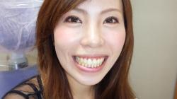 ホワイトニング初めてです!